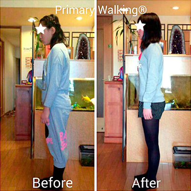 Cさん(14歳 女性) ◆ 姿勢の改善